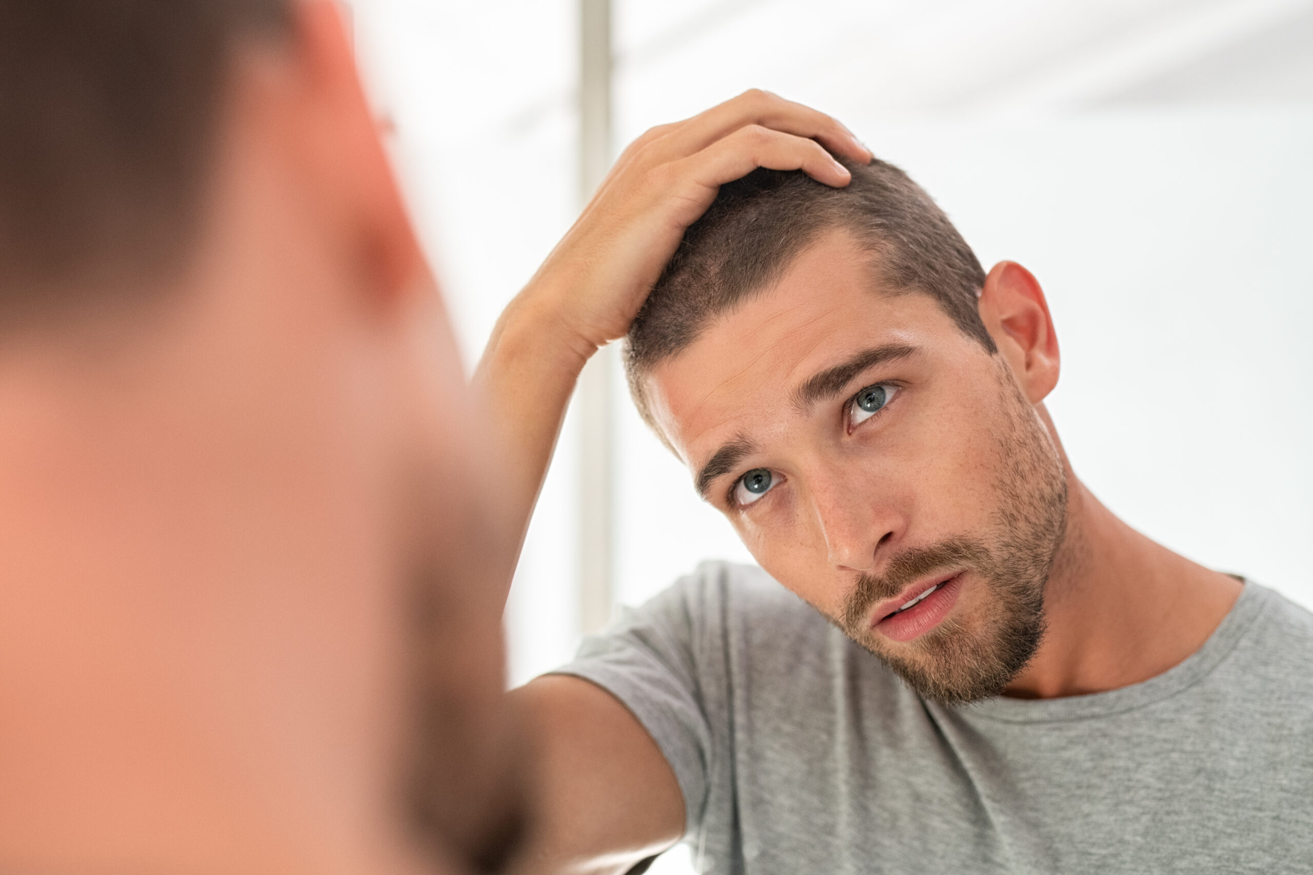 Understanding the 7 Stages of Male Pattern Baldness