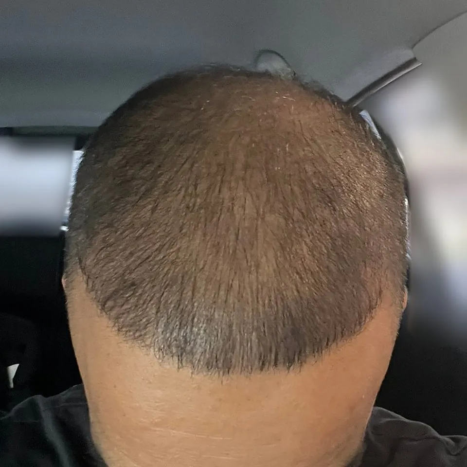 After: the same customer's crown from above