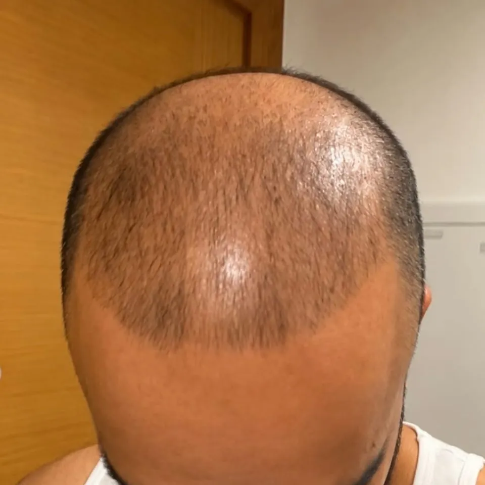 Before: a customer's crown from above