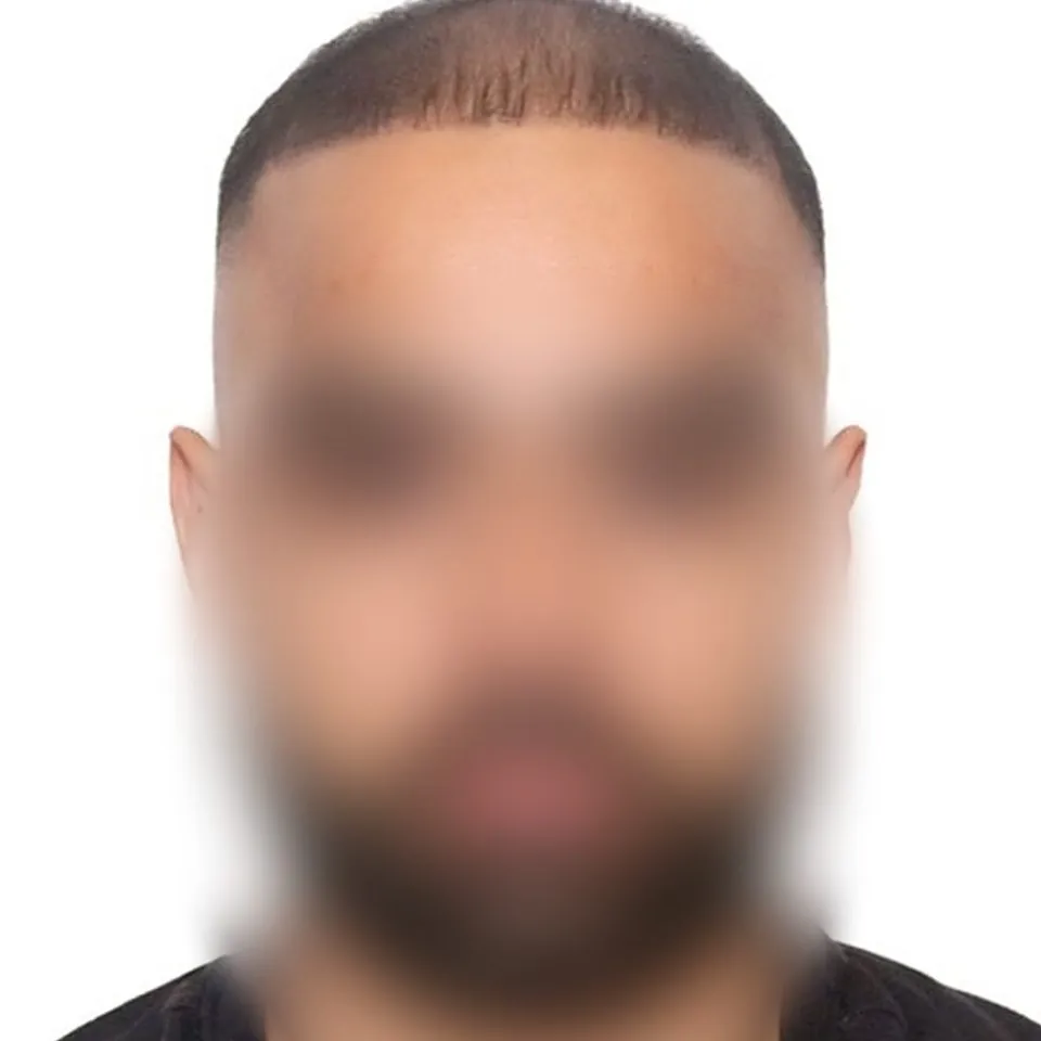 After: the same customer's hairline from the front, face blurred