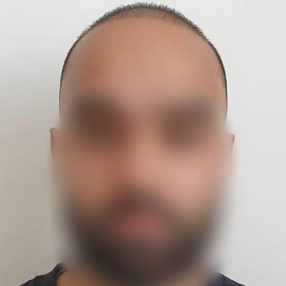Before: a customer's hairline from the front, face blurred