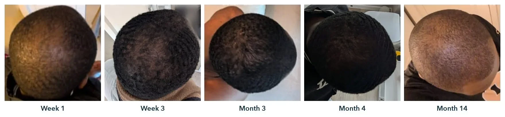 One customer's hair from above at week 1, week 3, month 3, month 4 and month 14